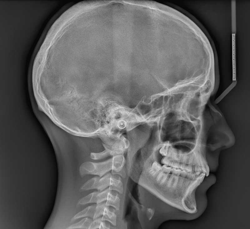 Zdjęcie cefalometryczne czaszki
